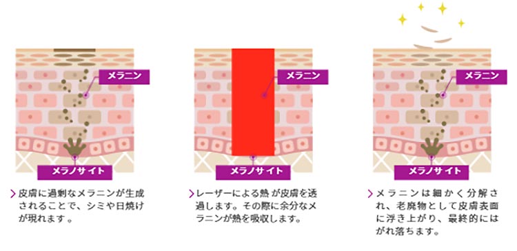 皮膚良性色素性疾患の治療